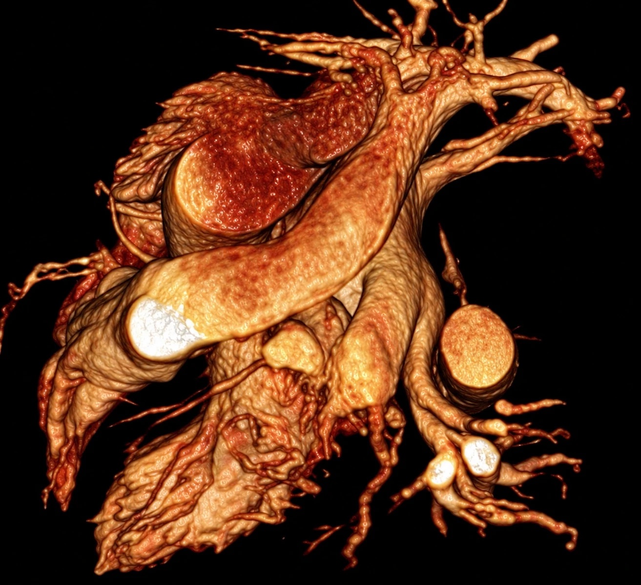 Ferumoxytol-enhanced MR angiography reconstruction
